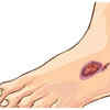 Non Healing Sores