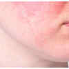 Persistent redness