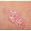 Rashes that do not get better