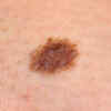 Notice pigment spreading beyond a mole