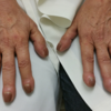 Unexplained finger clubbing