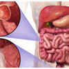 Blood in stool