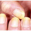 Yellow Nails