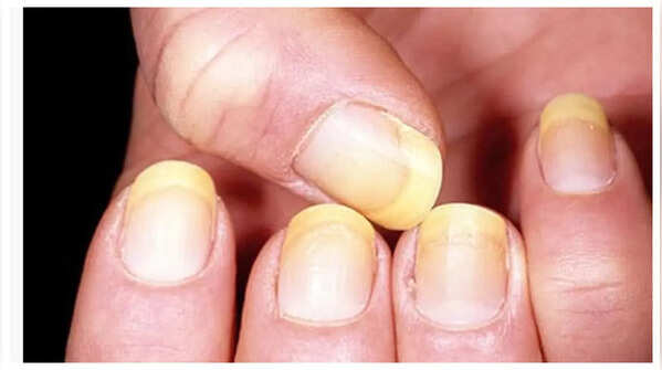 Yellow Nails