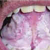 White patch in the mouth