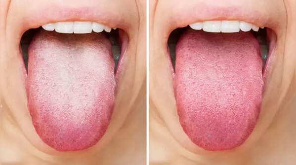 Sore tongue