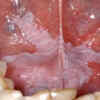 Patches inside the mouth