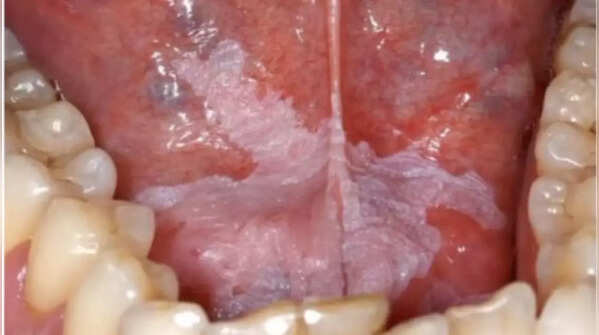 Patches inside the mouth
