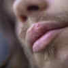 Lump on the lip