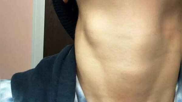 Lump in the neck