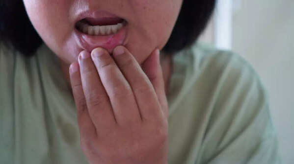 An ulcer in the mouth area