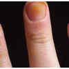 Nail Discoloration