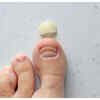 Nail Lifting