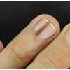 Dark Streaks or Bands Under the Nail