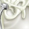 Myth 2: “It won’t feel natural after surgery”
