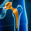 Myth 1: “I’m too young for a joint replacement”