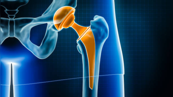 Myth 1: “I’m too young for a joint replacement”