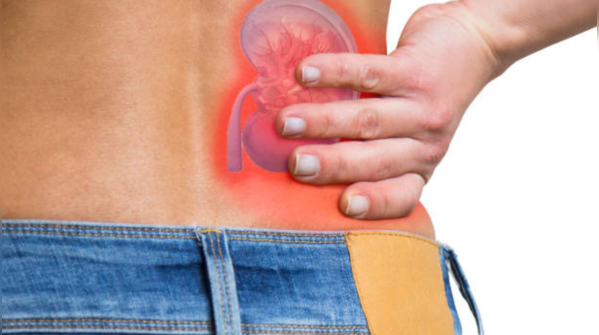 Kidney stones
