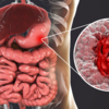 Gut inflammation