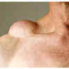 Painless lump or swelling