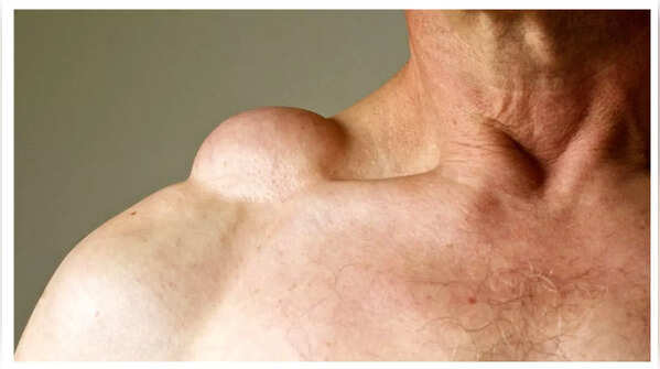 Painless lump or swelling