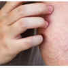Persistent, Unexplained Itchy Skin