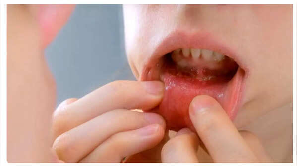 Mouth sores