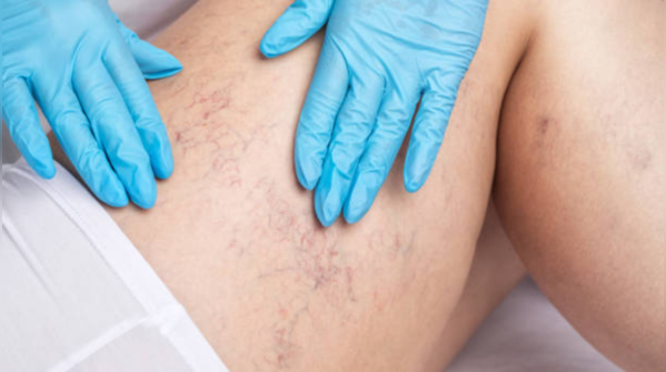 Can CVI hint at other health issues?