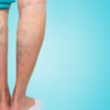 So, what is Chronic Venous Insufficiency?