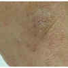 Leads to Skin Changes and Hormonal Problems