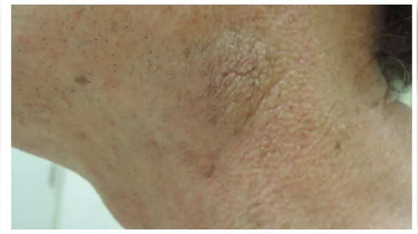 Leads to Skin Changes and Hormonal Problems