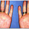 Red Palms (Palmar Erythema)