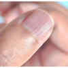 Vertical Ridges on Fingernails