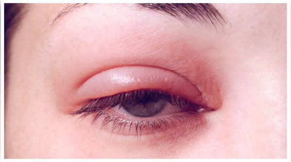 Persistent Eye Redness, Irritation, or Pain