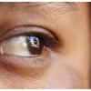 Loss of Peripheral Vision