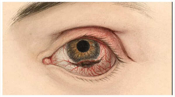 Change in Pupil Shape or Size
