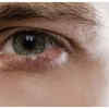 Dark Spots on the Colored Part of the Eye