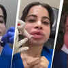 Uorfi Javed gets her lip fillers dissolved after nine years