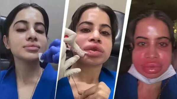 Uorfi Javed gets her lip fillers dissolved after nine years