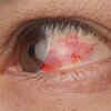 Bloodshot eyes