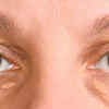 Xanthelasma