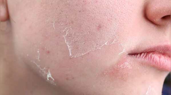 Skin issues or peeling