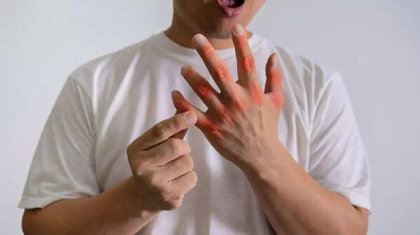 Swelling and redness in joints