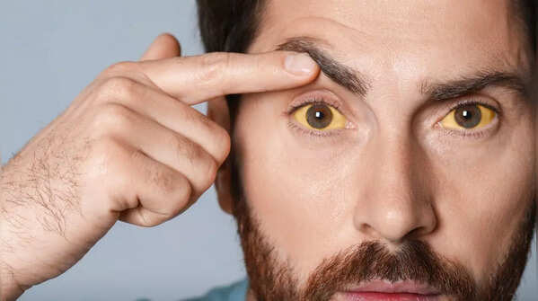 Mild jaundice (i.e. yellowing of skin or eyes)