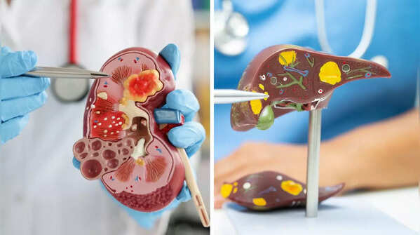 Kidney Stones and Gallstones: Key differences