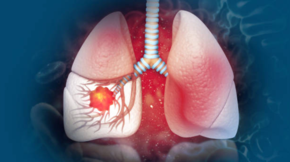 Advanced treatment options for lung cancer are very expensive