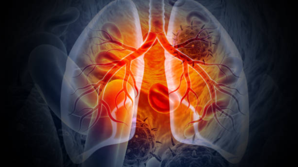 Treatment of Lung cancer is toxic and worse than the disease itself