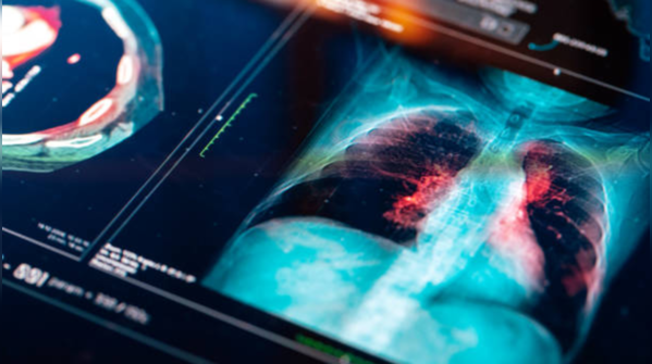 There is no screening test for lung cancer