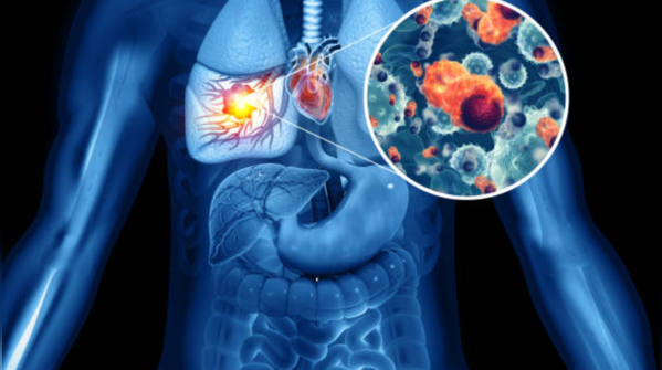 Lung cancer does not happen in youngsters / women