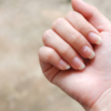 Hair thinning, skin issues, and brittle nails